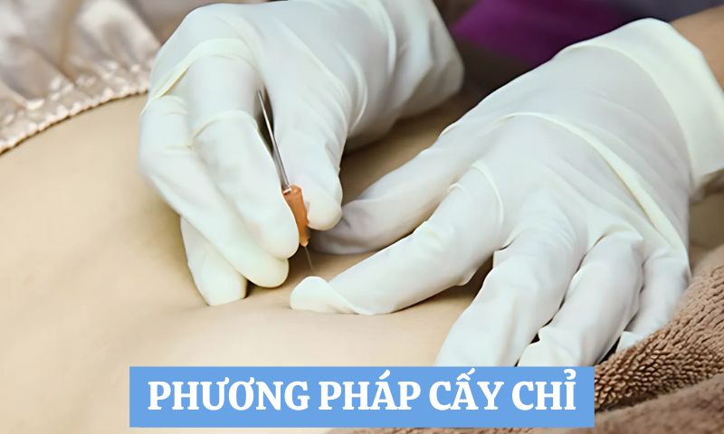 phương pháp chữa bệnh theo Y học Cổ truyền cấy chỉ 