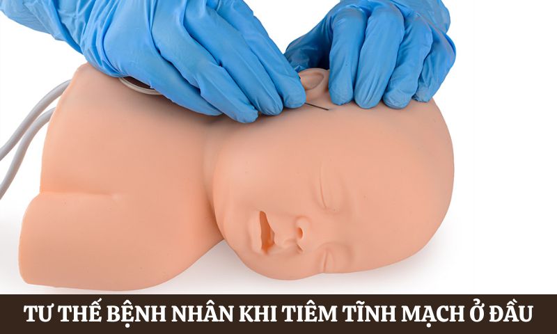 Tư thế bệnh nhân khi tiêm tĩnh mạch ở vùng đầu